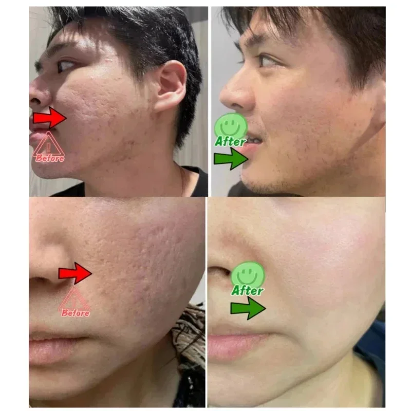 Salicylsäure Poren Clearing Cr – Korean Skincare Routine Bewertung und Preis